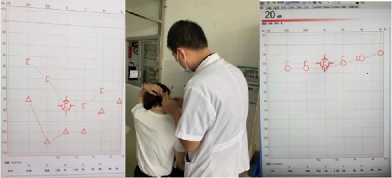 突發(fā)性耳聾被治愈！萬載縣人民醫(yī)院成功開展耳后、鼓室內(nèi)給藥技術(shù)